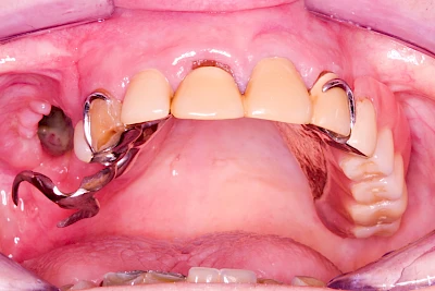 Beispiele: Wundheilungsstörung