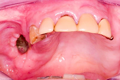 Beispiele: Wundheilungsstörung