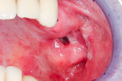 Beispiele: Wundheilungsstörung