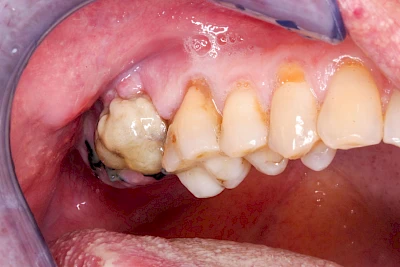 Beispiele: Wundheilungsstörung