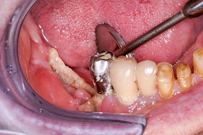 Beispiele: Wundheilungsstörung