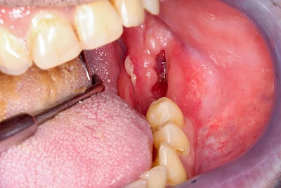 Beispiele: Wundheilungsstörung