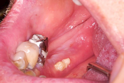 Beispiele: Wundheilungsstörung