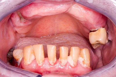 Beispiele: Wundheilungsstörung