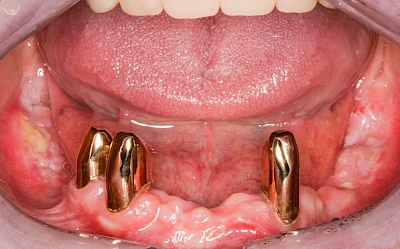 Beispiele: Wundheilungsstörung