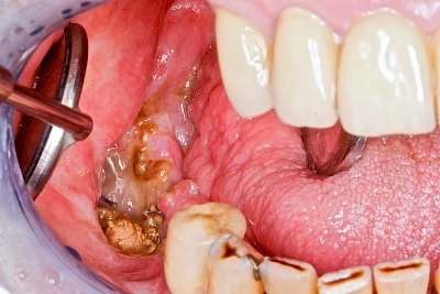 Beispiele: Wundheilungsstörung