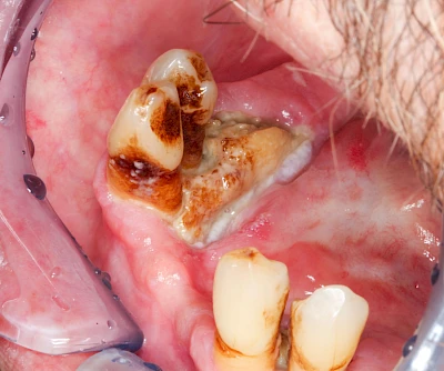 Beispiele: Wundheilungsstörung