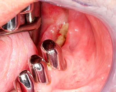 Beispiele: Wundheilungsstörung