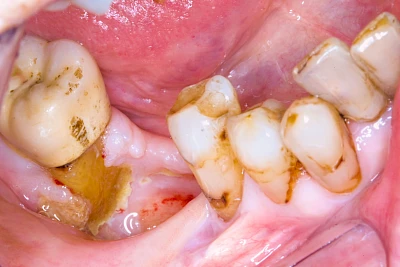 Beispiele: Wundheilungsstörung