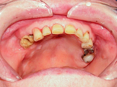 Beispiele: Wundheilungsstörung