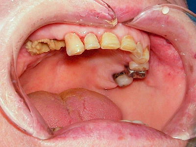 Beispiele: Wundheilungsstörung