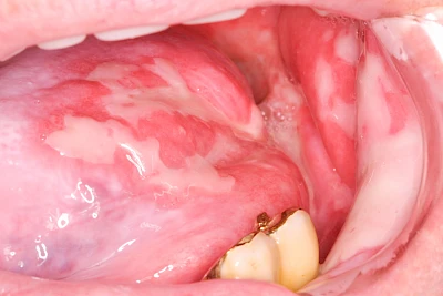 Beispiele: Mukositis