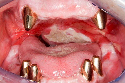 Beispiele: Mukositis