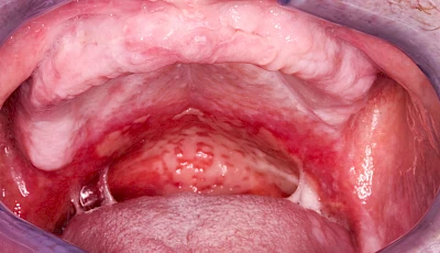 Beispiele: Mukositis