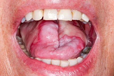 Beispiele: Mukositis