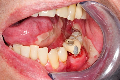 Beispiele: Mukositis