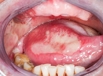 Beispiele: Mukositis