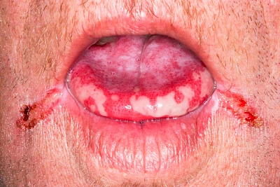 Beispiele: Mukositis