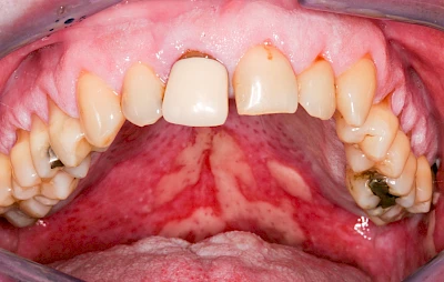 Beispiele: Mukositis