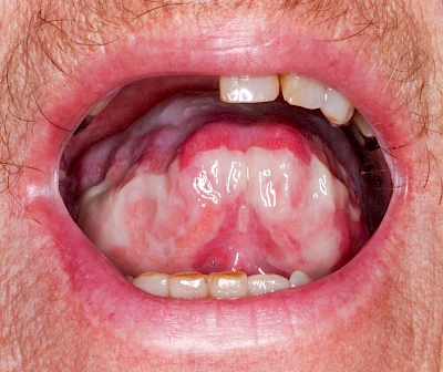 Beispiele: Mukositis