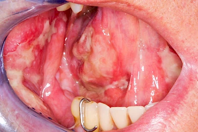 Beispiele: Mukositis