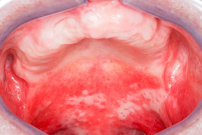 Beispiele: Mukositis