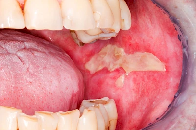 Beispiele: Mukositis