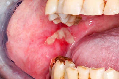 Beispiele: Mukositis