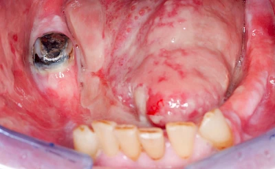 Beispiele: Mukositis