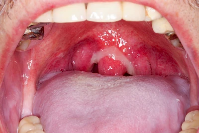 Beispiele: Mukositis