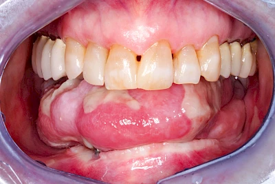 Beispiele: Mukositis