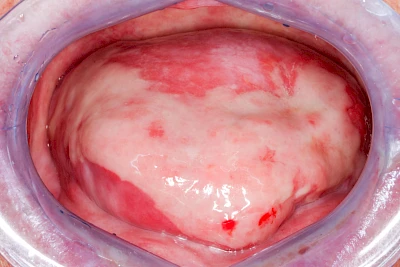 Beispiele: Mukositis