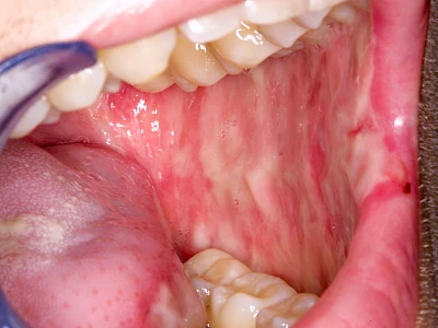 Beispiele: Mukositis