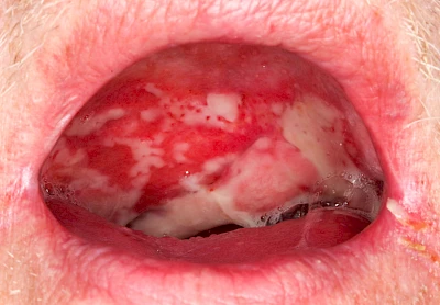 Beispiele: Mukositis