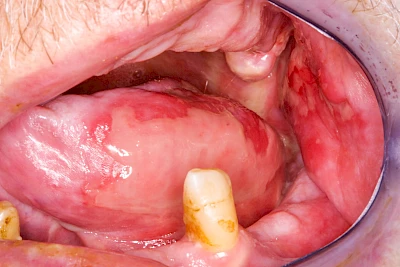Beispiele: Mukositis