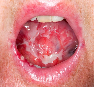 Beispiele: Mukositis