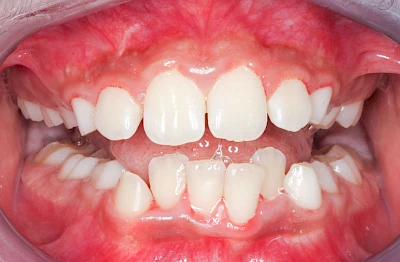 Beispiele: Pigmentstörung