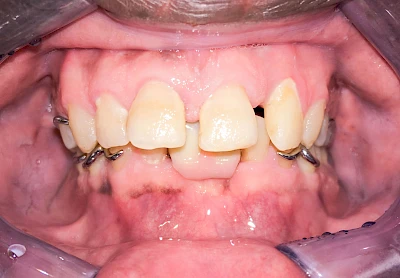 Beispiele: Pigmentstörung