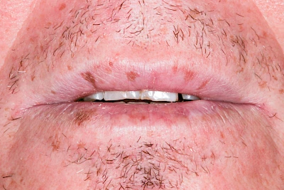 Beispiele: Pigmentstörung