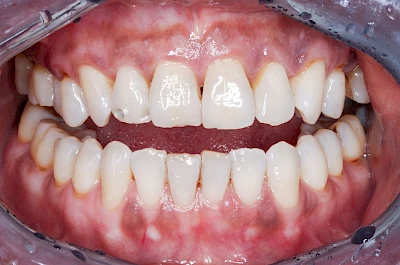 Beispiele: Pigmentstörung