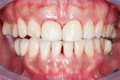 Beispiele: Pigmentstörung