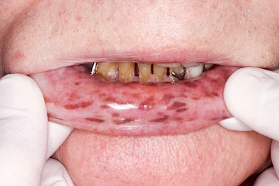 Beispiele: Pigmentstörung