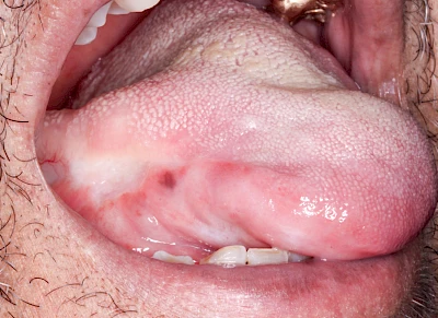 Beispiele: Pigmentstörung