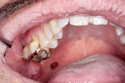 Beispiele: Pigmentstörung