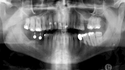 Beispiele: Implantatplanung