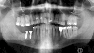 Beispiele: Implantatplanung