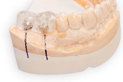Beispiele: Implantatplanung