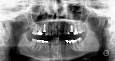 Beispiele: Implantatplanung
