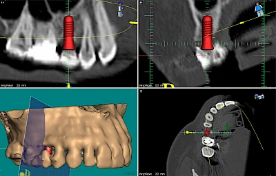 Beispiele: Implantatplanung