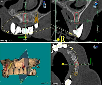 Beispiele: Implantatplanung